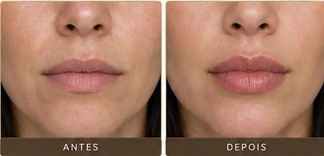Antes e depois ilustrativo, Couture Lips