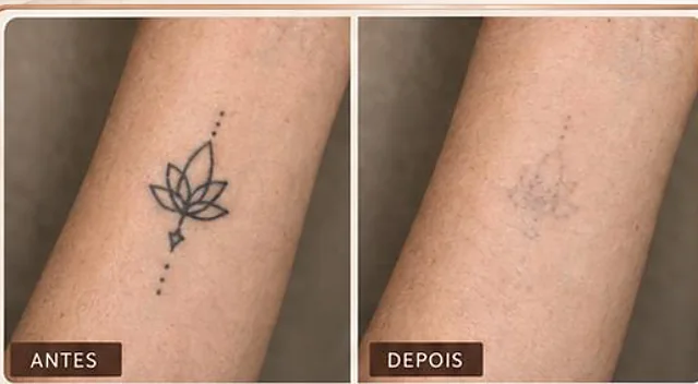 Antes e depois ilustrativo, Ink Erase