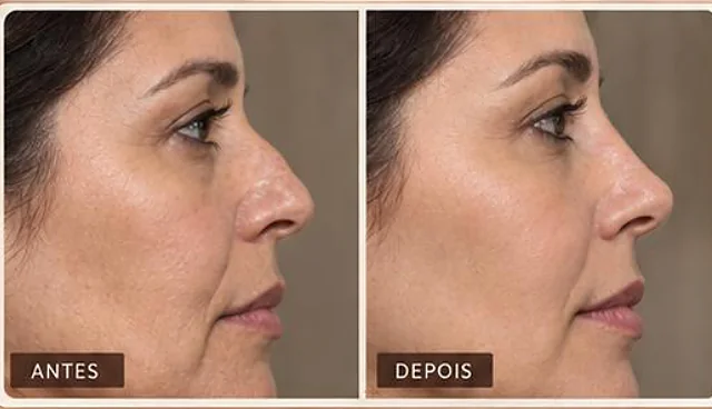 Antes e depois ilustrativo, K Nose Design